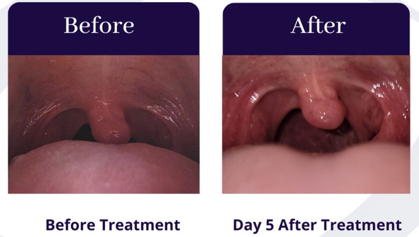 DEKA QuietNite Results - 5 Days After Treatment