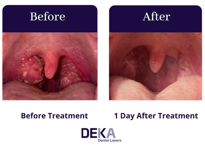 DEKA QuietNite Results - 1 Day After Treatment